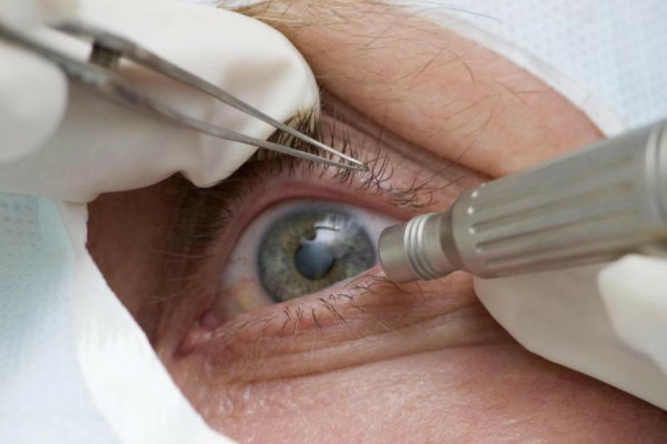 Cirurgia que altera cor do olho tem uso restrito para pessoas cegas