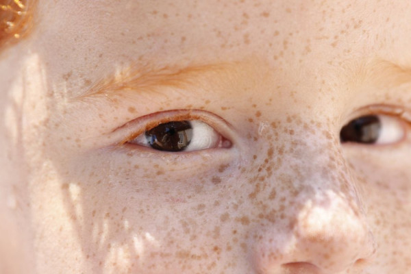 Reflexo branco nos olhos: entenda condição que assusta pais