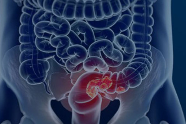 Pacientes com câncer colorretal são diagnosticados em estágio avançado