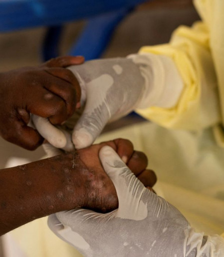 Brasil registra 88 casos de Mpox em 2026; saiba como evitar a doença