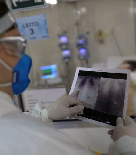 Broncopneumonia: entenda quadro que causou internação de Bolsonaro