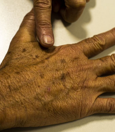 Desinformação sobre câncer de pele afeta diagnóstico, diz instituição