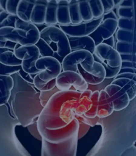 SUS adota novo exame para rastrear câncer colorretal na população