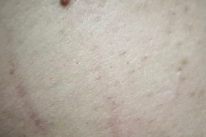 Marcas da agressão sofrida por enfermeira da rede municipal de saúde