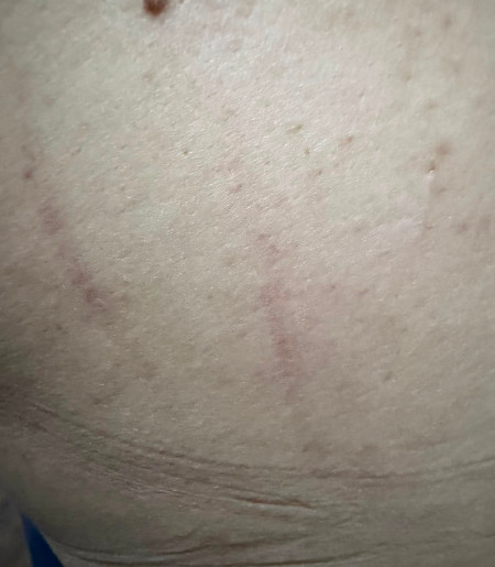 Marcas da agressão sofrida por enfermeira da rede municipal de saúde