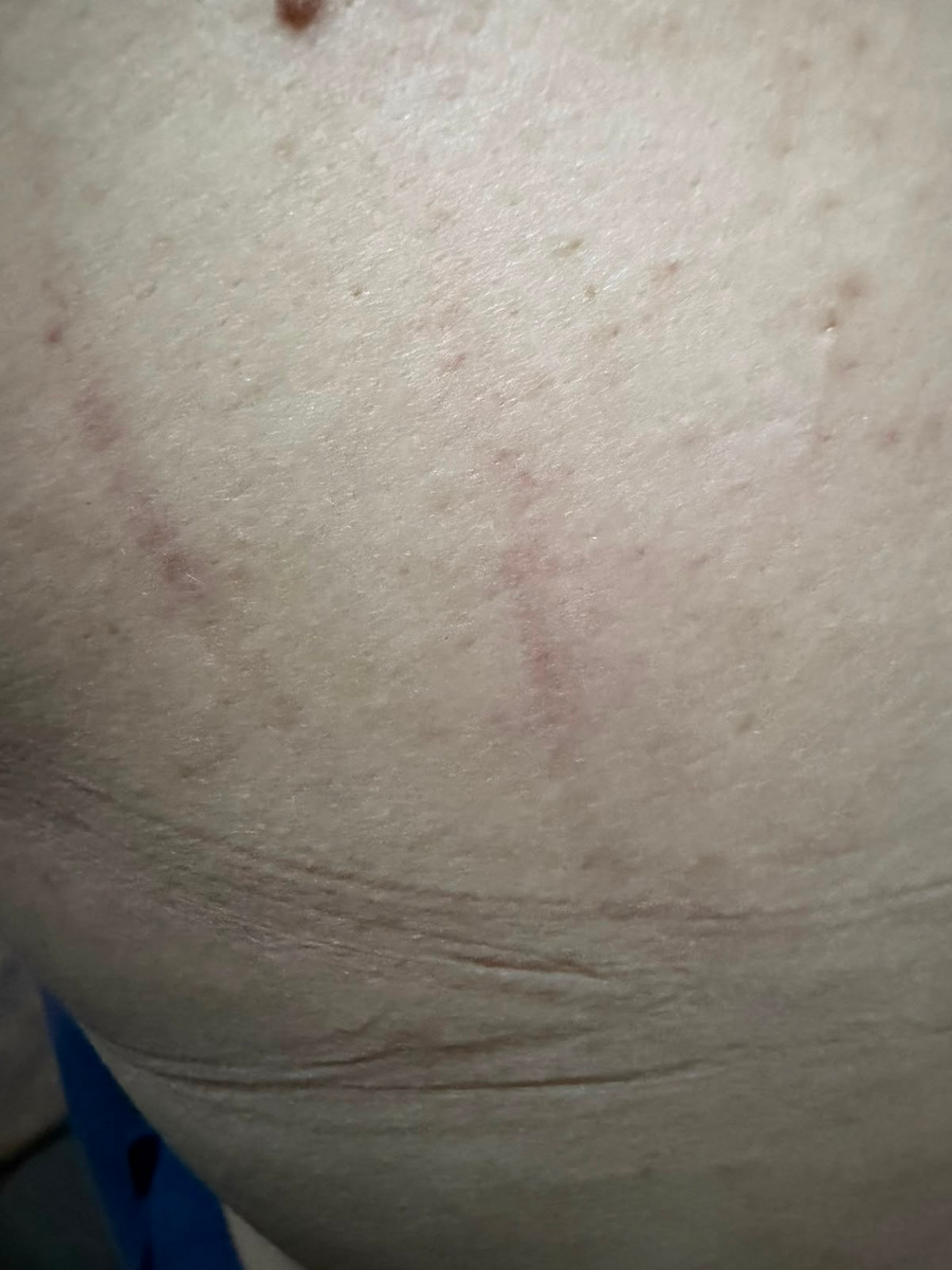 Marcas da agressão sofrida por enfermeira da rede municipal de saúde