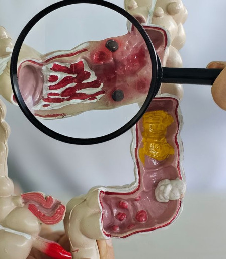 Em 13 anos, doença inflamatória intestinal cresce 5 vezes no Brasil