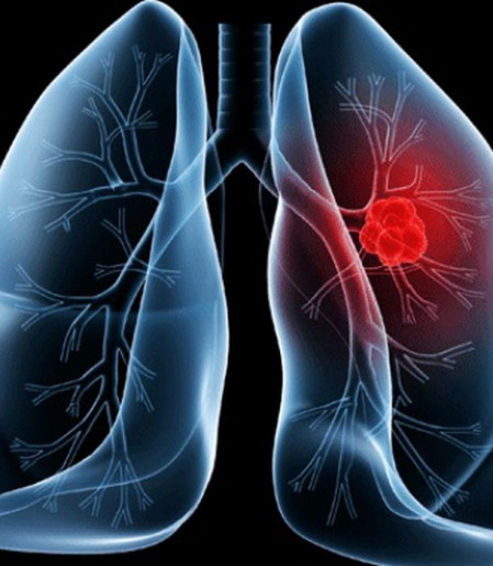 Saiba o que é adenocarcinoma pulmonar, câncer que atinge o papa