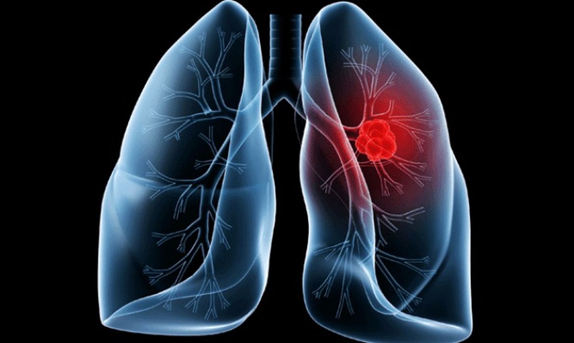 Saiba o que é adenocarcinoma pulmonar, câncer que atinge o Papa Leão 