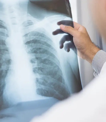 Anvisa aprova novo medicamento para câncer de pulmão avançado